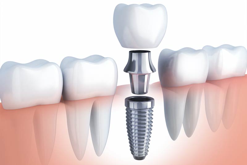 Implants Dentist in Mandeville