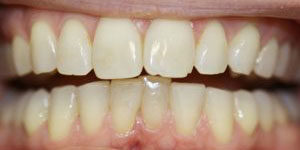 Gap Between Teeth