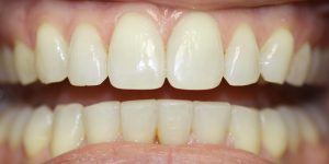 Gap, Filling in Teeth