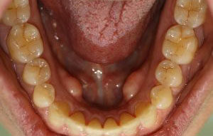 Teeth Whitening in Mandeville